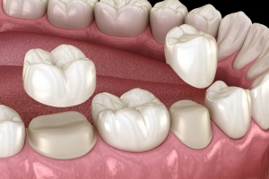 Getting a Dental Crown: Things to Know Getting a Dental Crown: Things to Know
